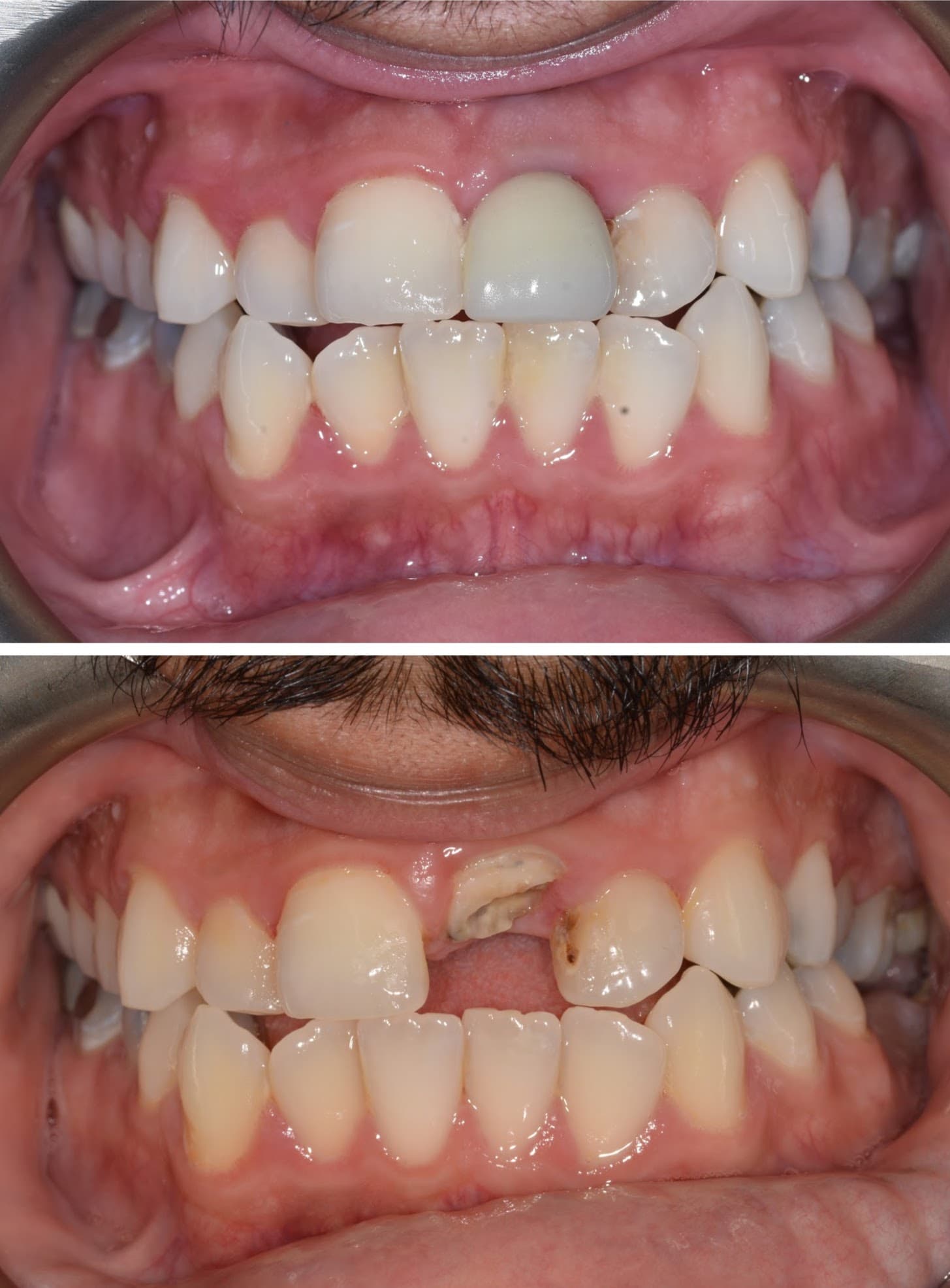 Cosmetic Dentistry - Before and After