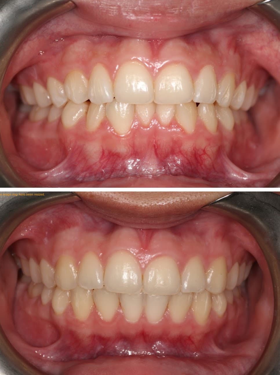 Dental Implants - Before and After